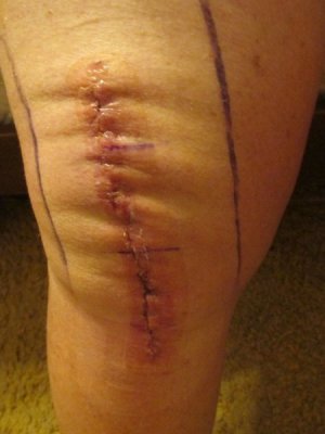 241001 002 bandage removed att 1 week 002.jpg